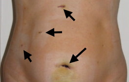 Bauchschnitte bei einer laparoskopischen Operation